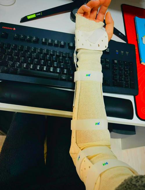 TFCC损伤康复日记 短臂支具的奇妙效果与假肢矫形器的启发